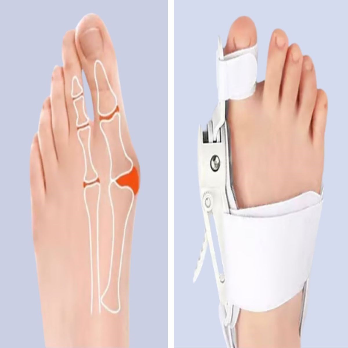 Ayarlanabilir Ayak Baş Parmak Kemik Düzeltici – Halluks Valgus (Bunyon) Aparatı, Gece Gündüz Kullanıma Uygun Ayak Düzeltme Ateli