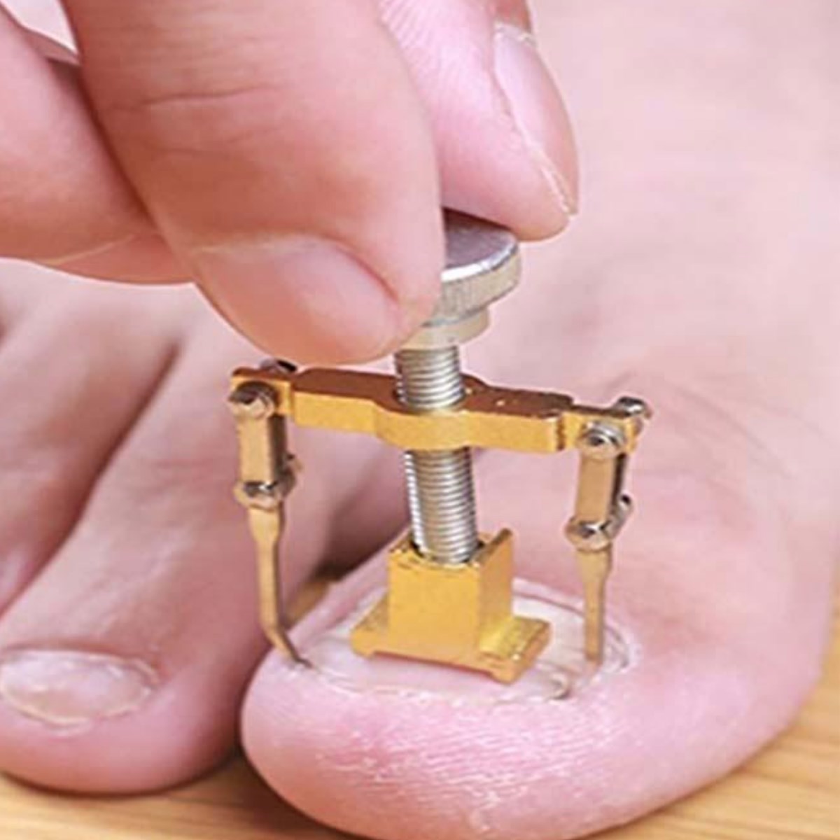 Batan Tırnak Düzeltme Aleti Batık Tırnak Çıkarıcı Aparat